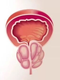 Inflammation de la prostate