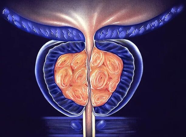 Prostatite bactérienne chronique chez les hommes