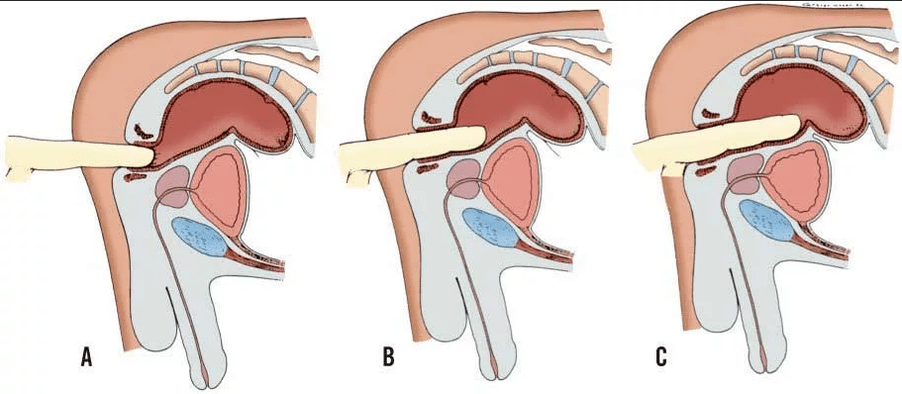 Examen rectal du doigt